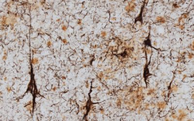 Actualidad sobre la enfermedad de Alzheimer