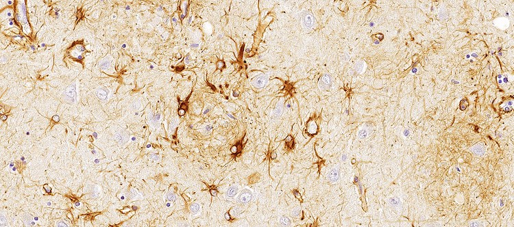 Astrocitos rodeando-placa de amiloide. Fundación CIEN